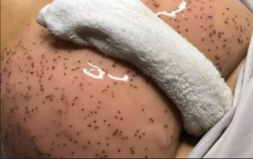 Butt Facial