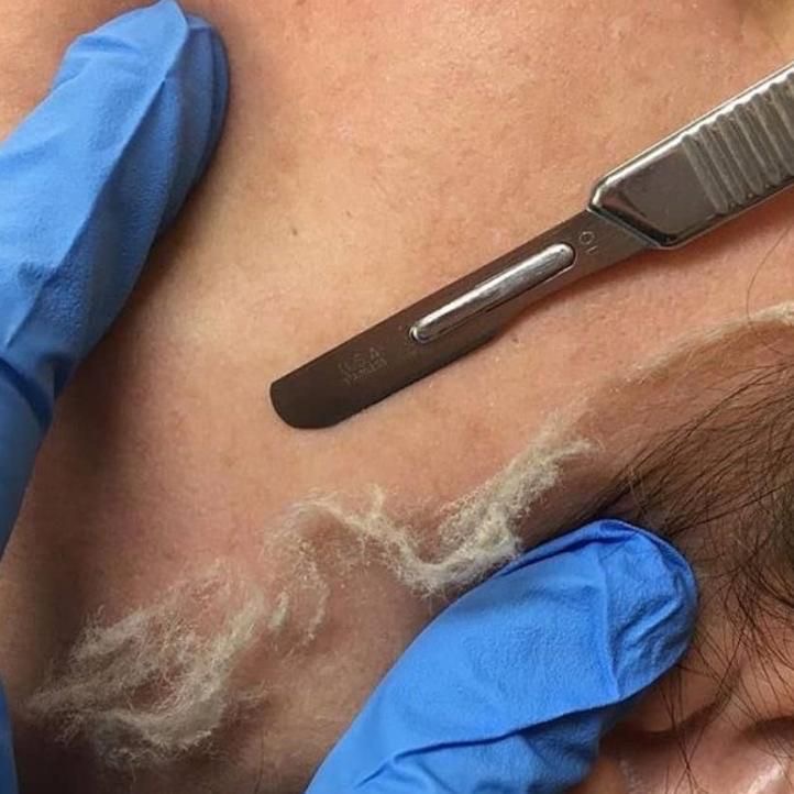 Dermaplane Facial