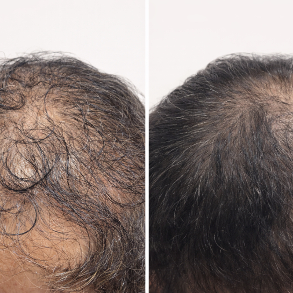 Hair Restoration at Hush & Glow in Lutz, FL