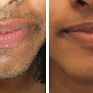 Laser Hair Removal / Lip and Chin at Finalé Hair Removal And Skin Care in Minnetonka, MN