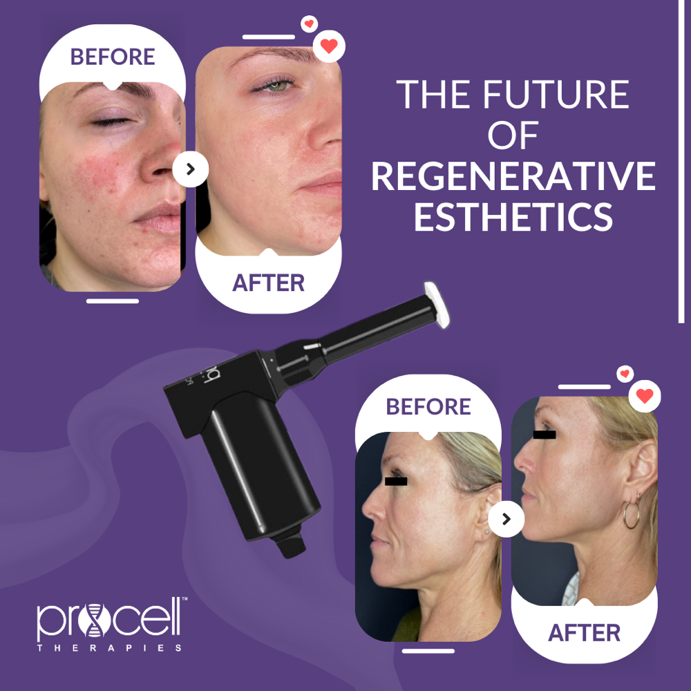 The Procell Magic Facial