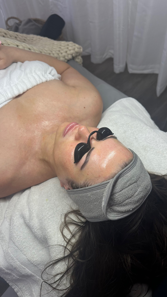 No Peel Chemical Peel