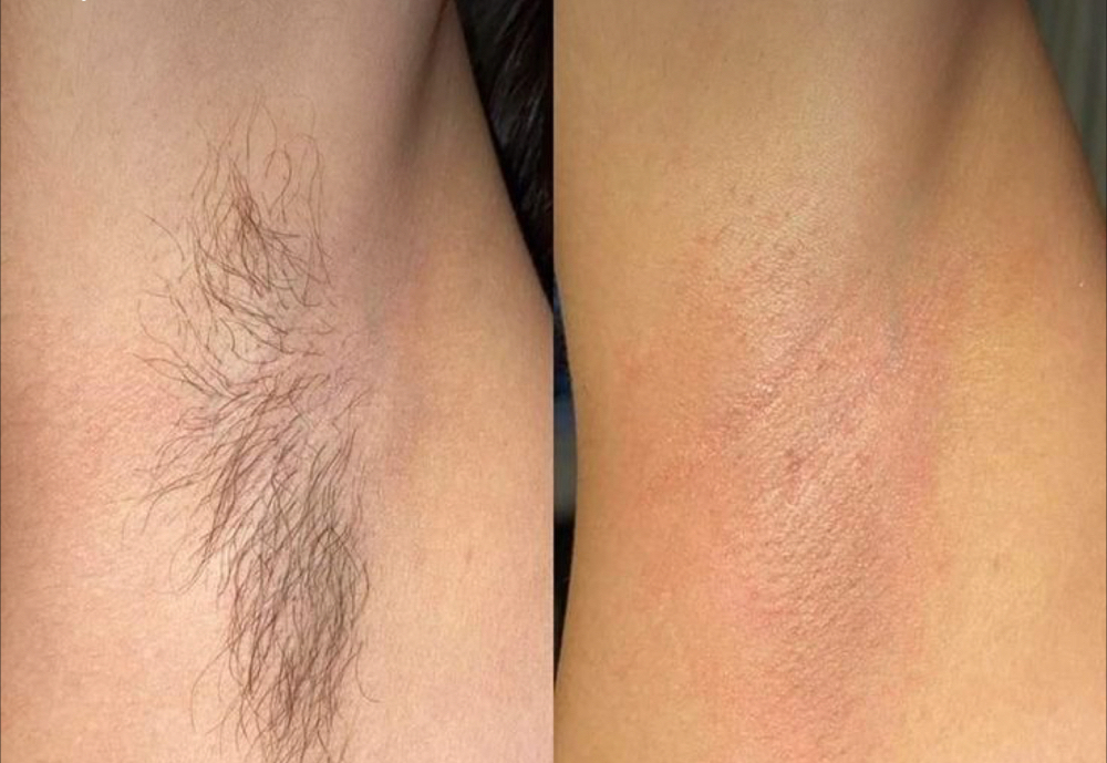Underarms