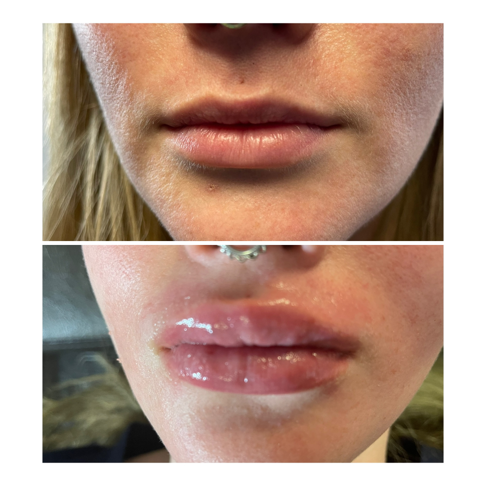 Hyluron Lip Plumping