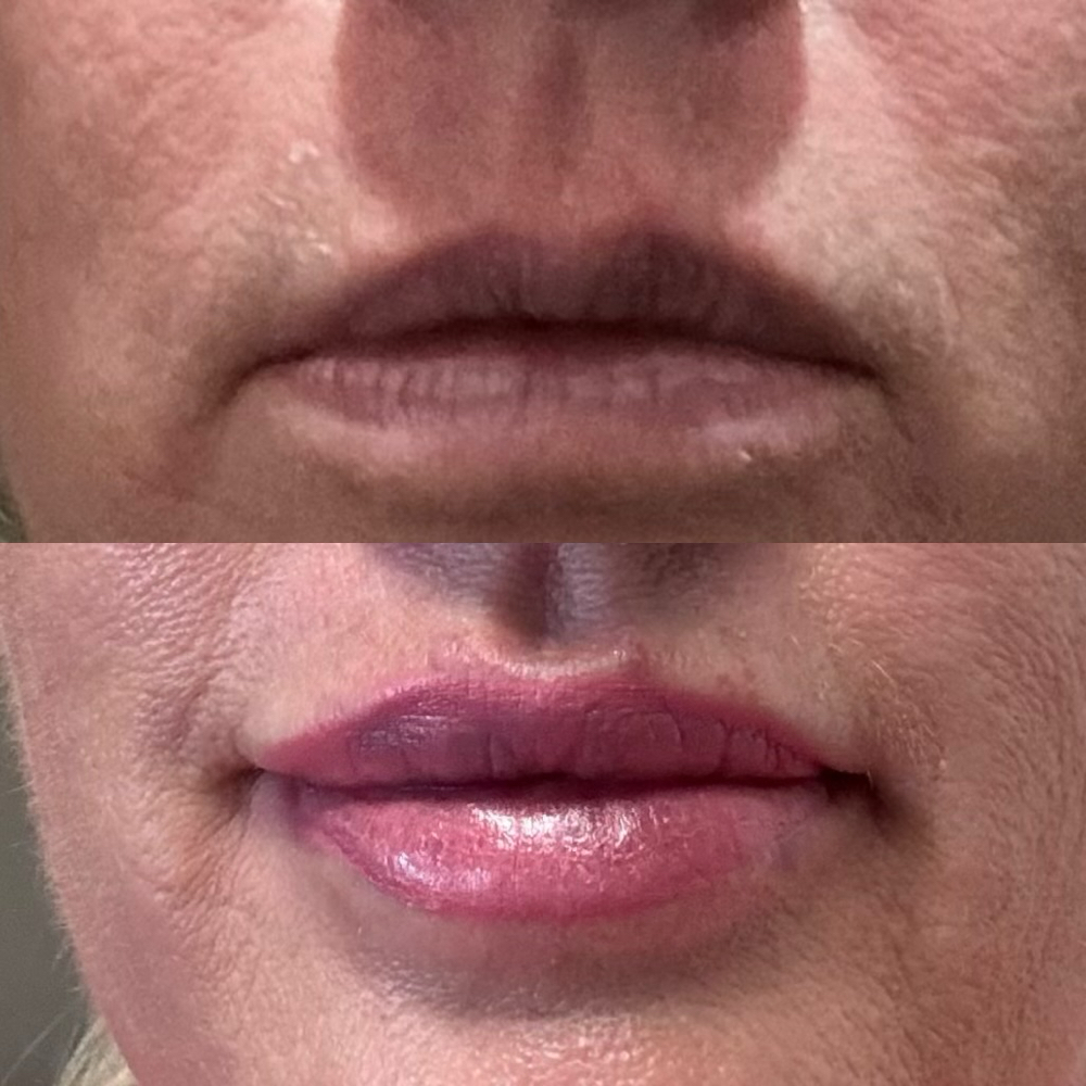 Lip Enhancement at Elan Aesthetics and Wellness in Colorado Springs, CO