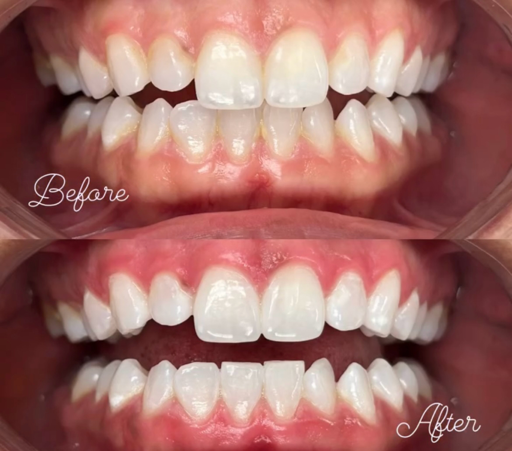 45 Minute Whitening Session