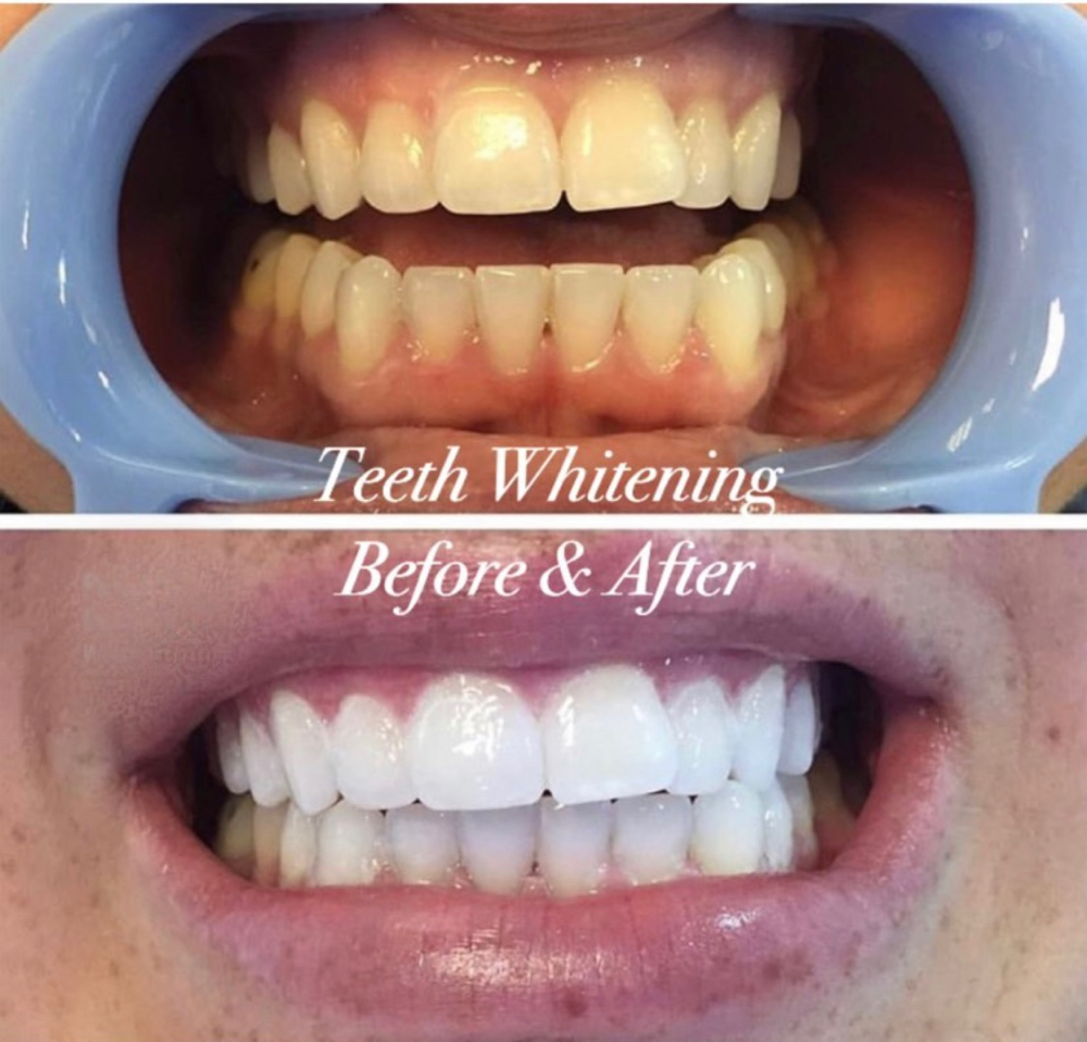 3 Dental Whitening Sessions