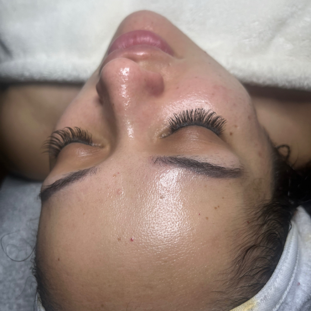 Nano Needling/Micro Channel Facial at Kohinoor Aesthetics By Marissa Elizabeth in San Antonio, TX