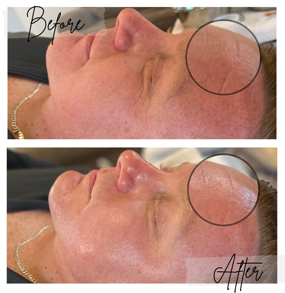 Microdermabrasion