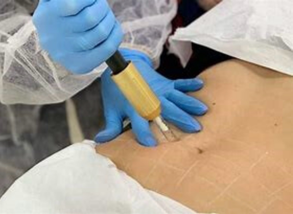 Fat Dissolve - Needle-Less