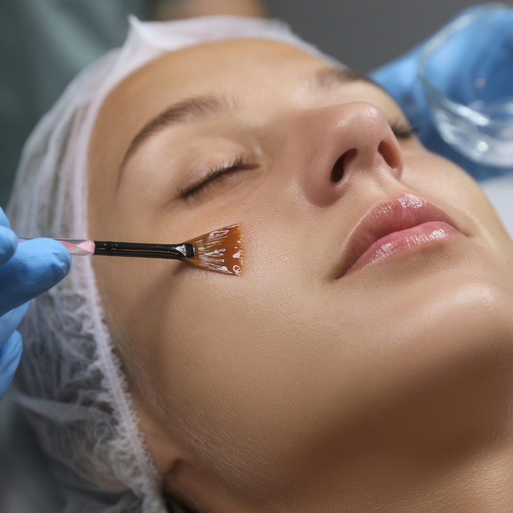 Chemical Peel