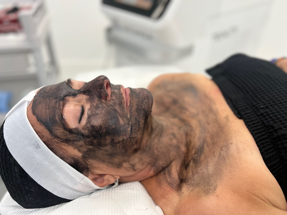 💎 Carbon Laser+Dermaplaning