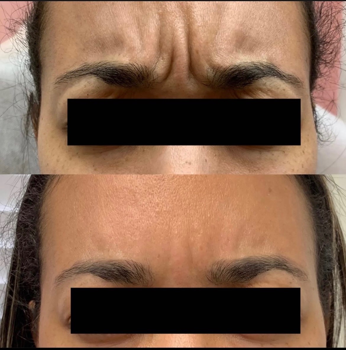 Botox