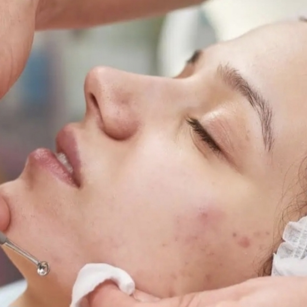 Acne-Fighting Facial