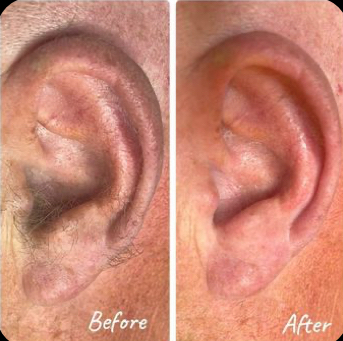 Ear Hair Removal- Waxing Service