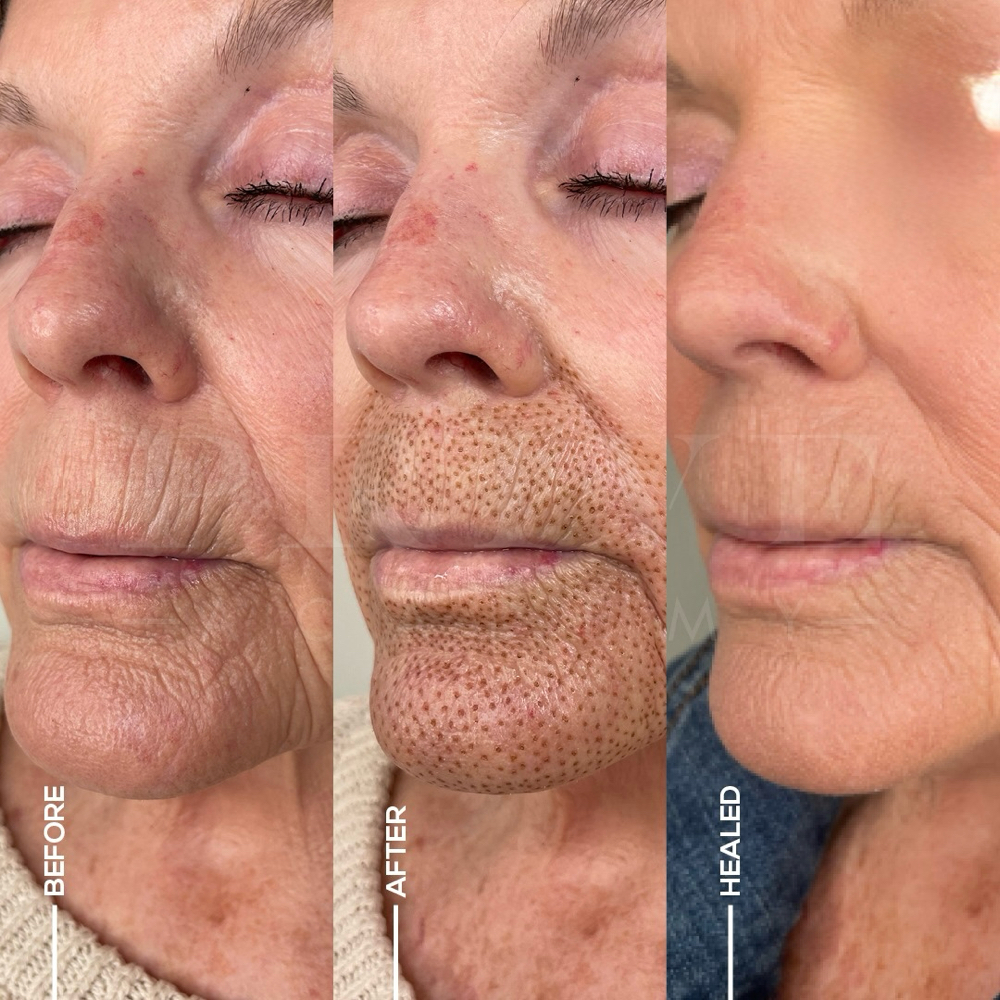 Fibroblast Plasma Skin Tightening