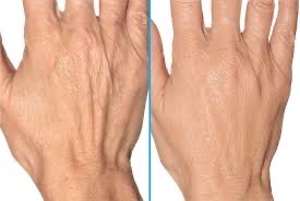 Dermal Fillers-Hands