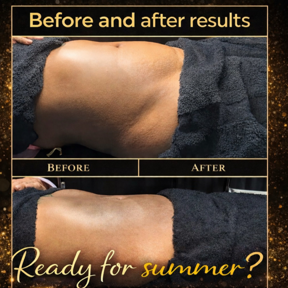 Limphatic Drainage Treatment at Obsession blessed med spa in Moreno Valley, CA