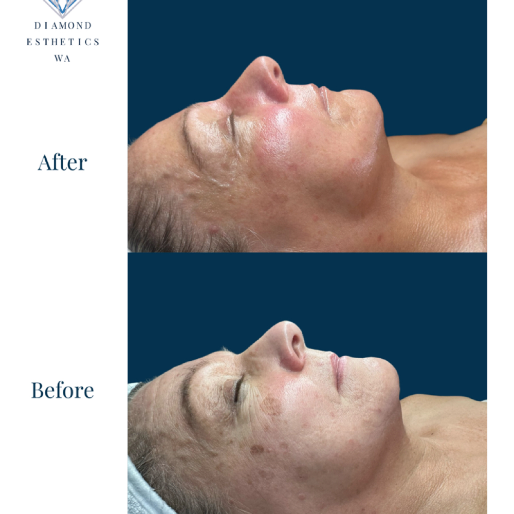 Concern Based Comprehensive Facial at Diamond Esthetics WA in Chehalis, WA