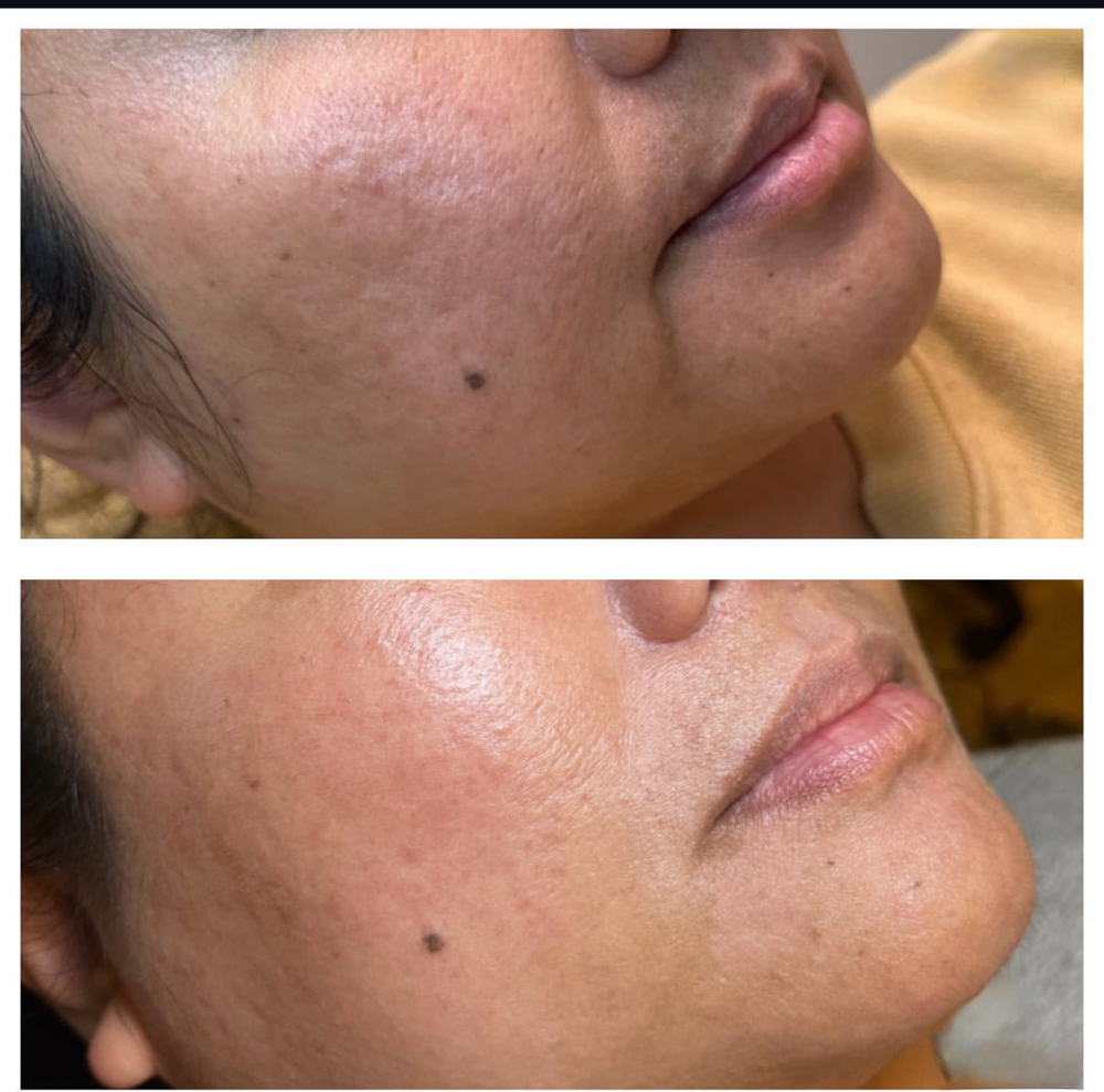 Skinpen Microneedling