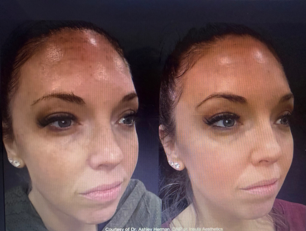Facial Rejuvenatiom