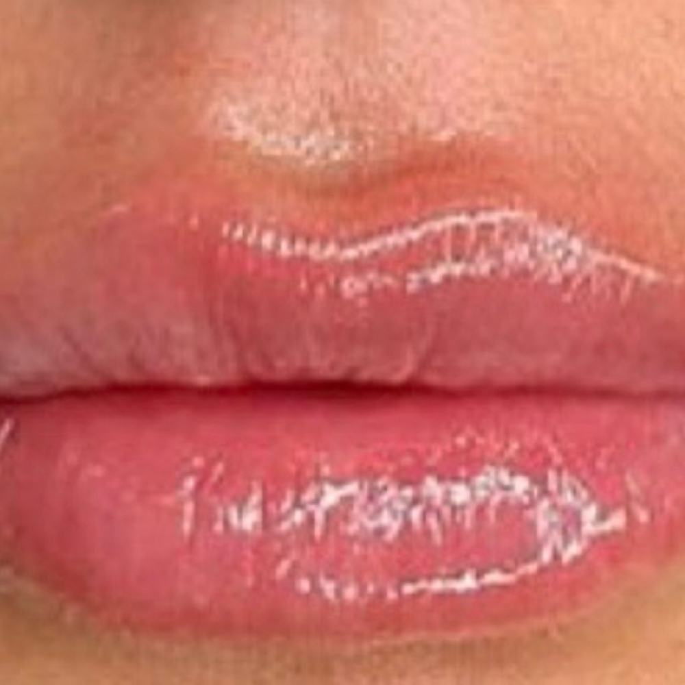 Lip Filler