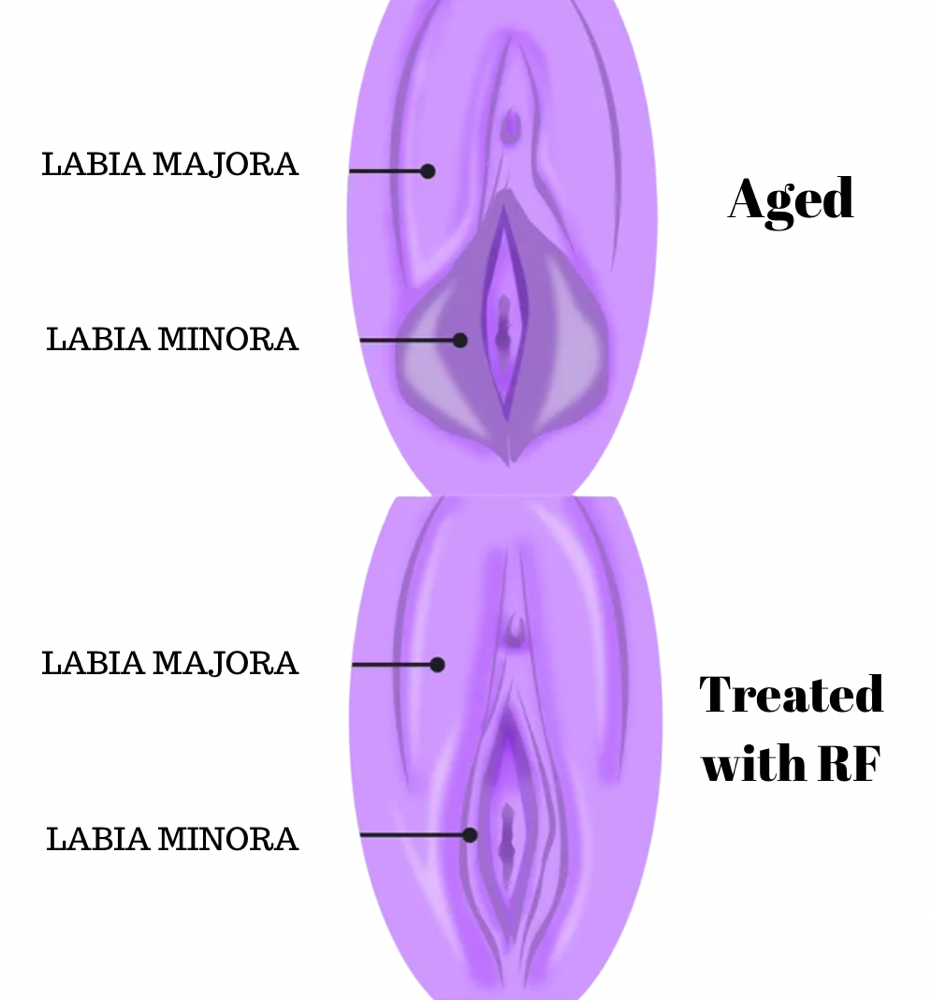 Labial Rejuvenation W/ RF