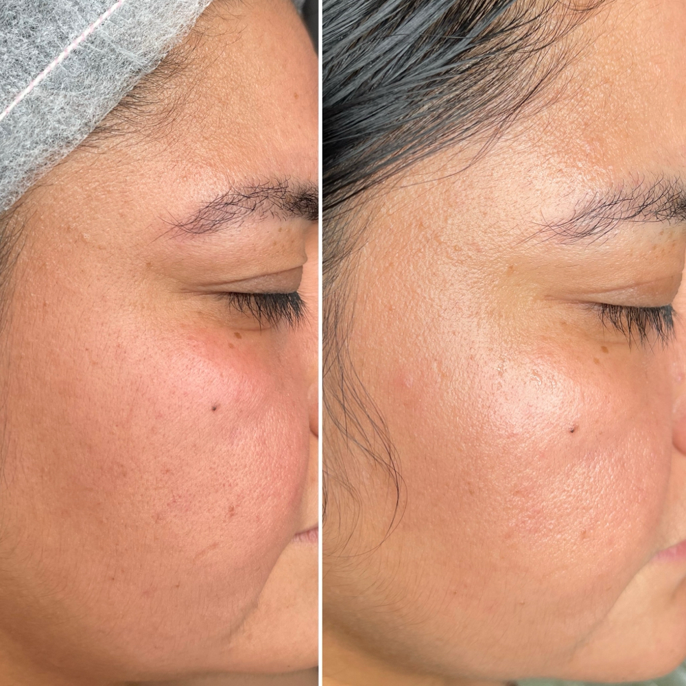 Peelings at Mimi Beauty Spa in Dallas, TX