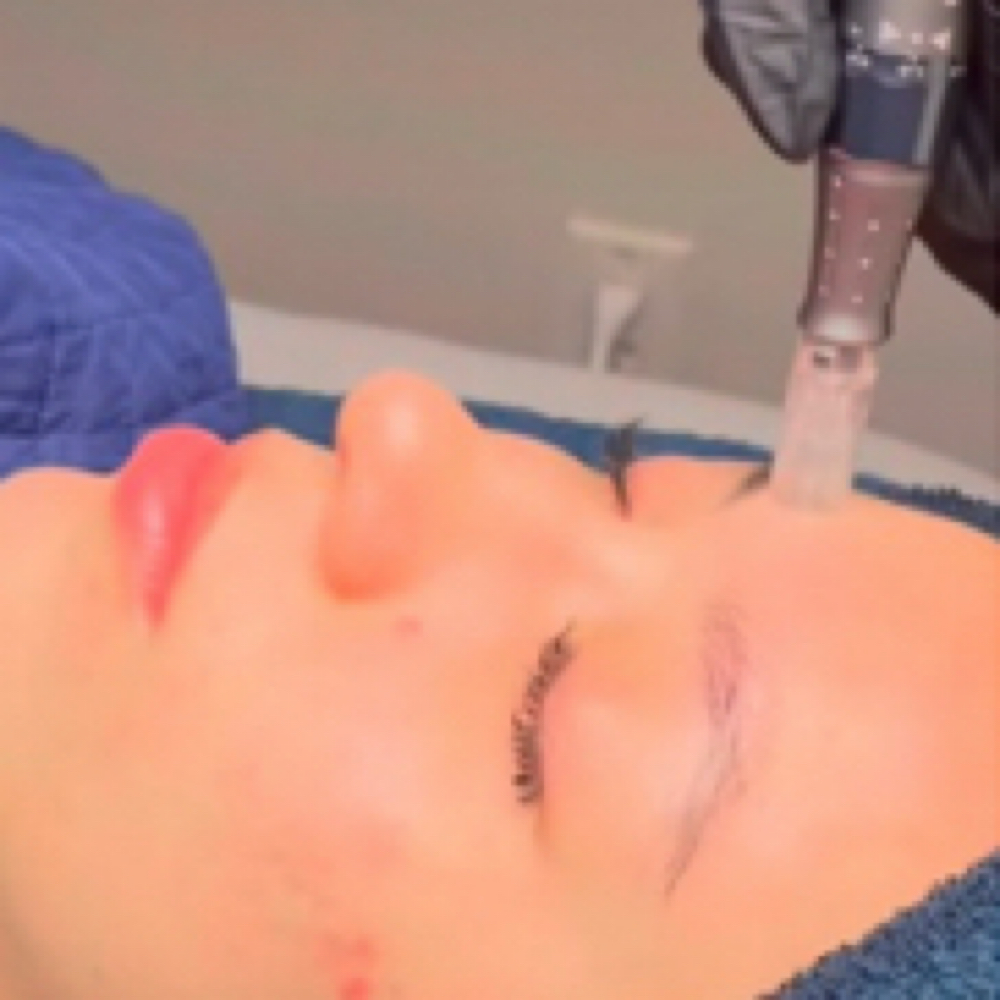 Serum infusion Add On