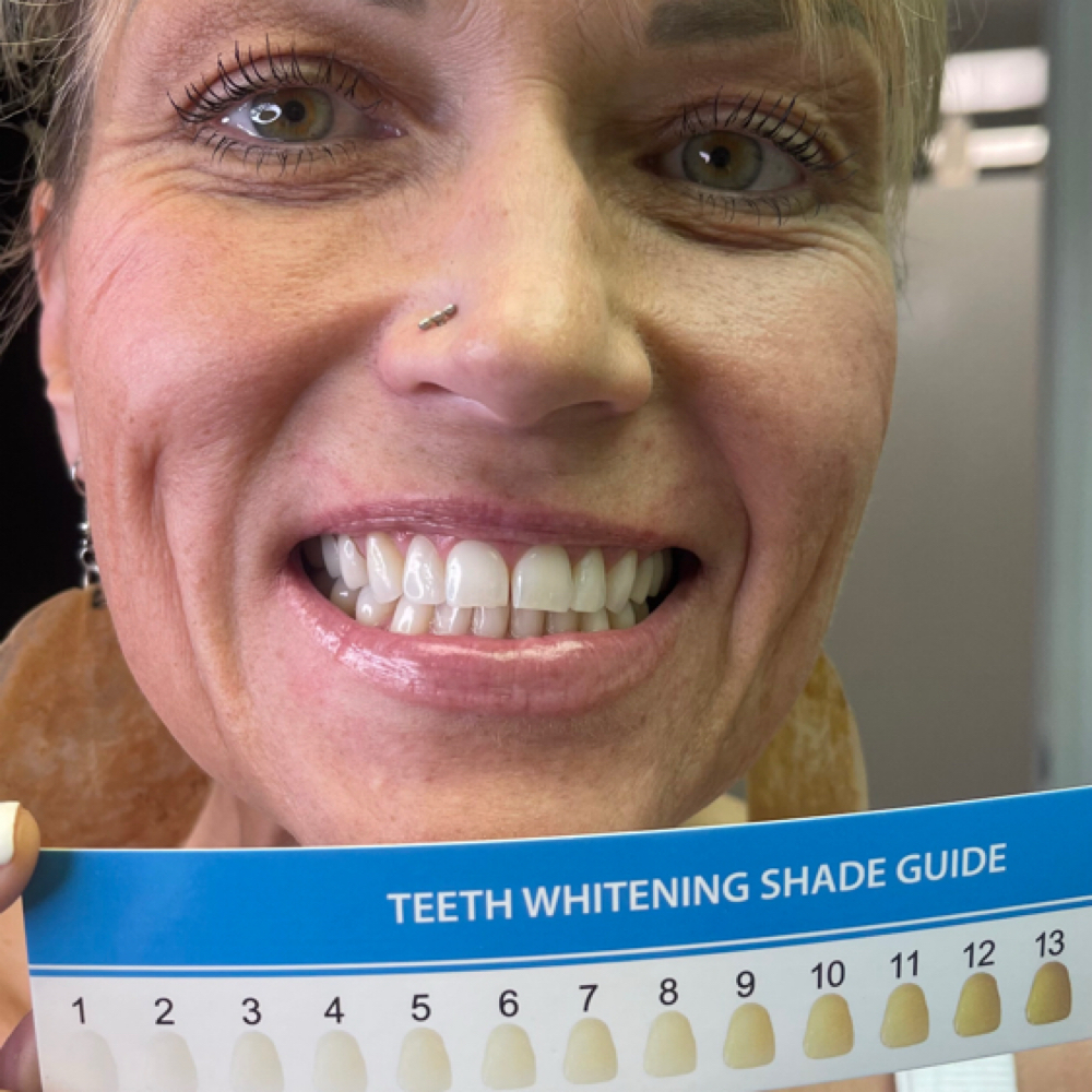 Teeth Whitening Treatment at Talia in Clovis, CA