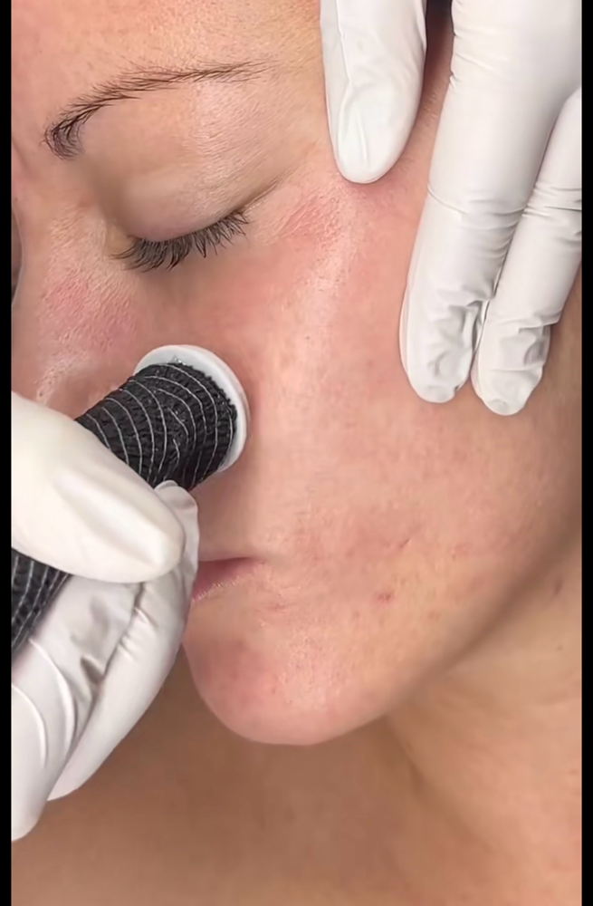Advanced Radiance Micro Channeling at Double Up Boutique in Warwick, RI