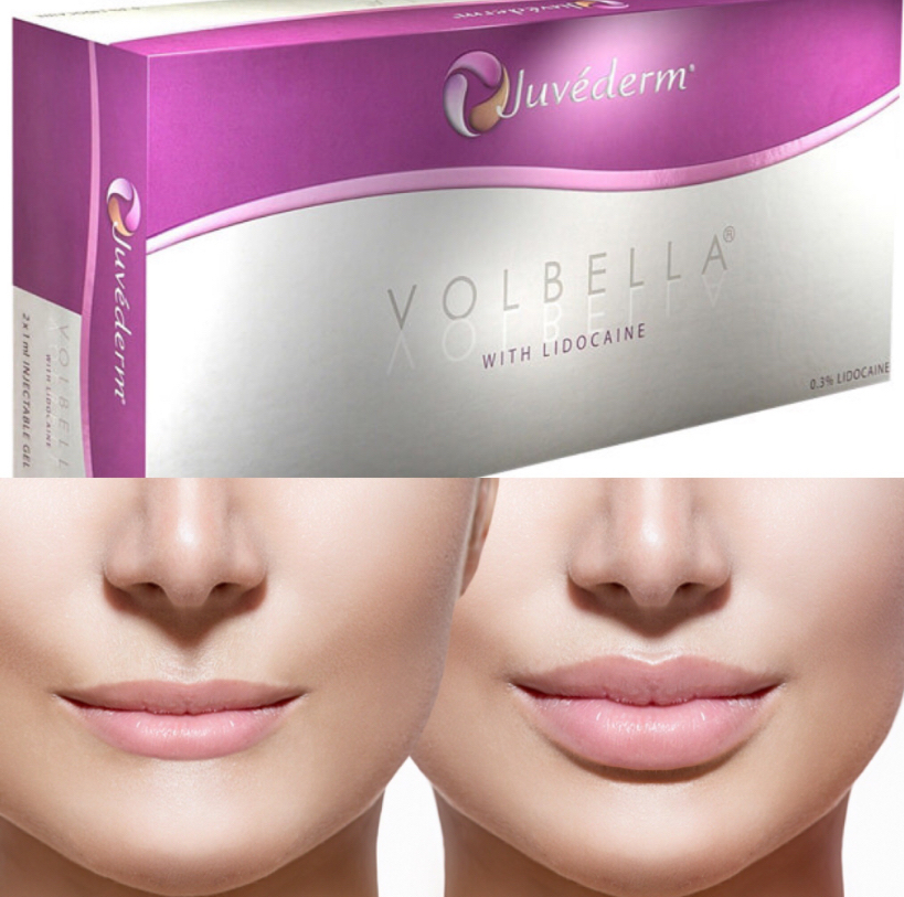 Juvaderm Volbella XC