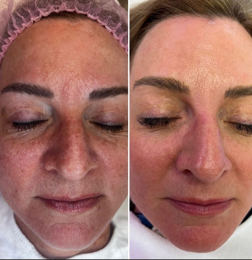 Facial Skin Tightening 3 Session Pk