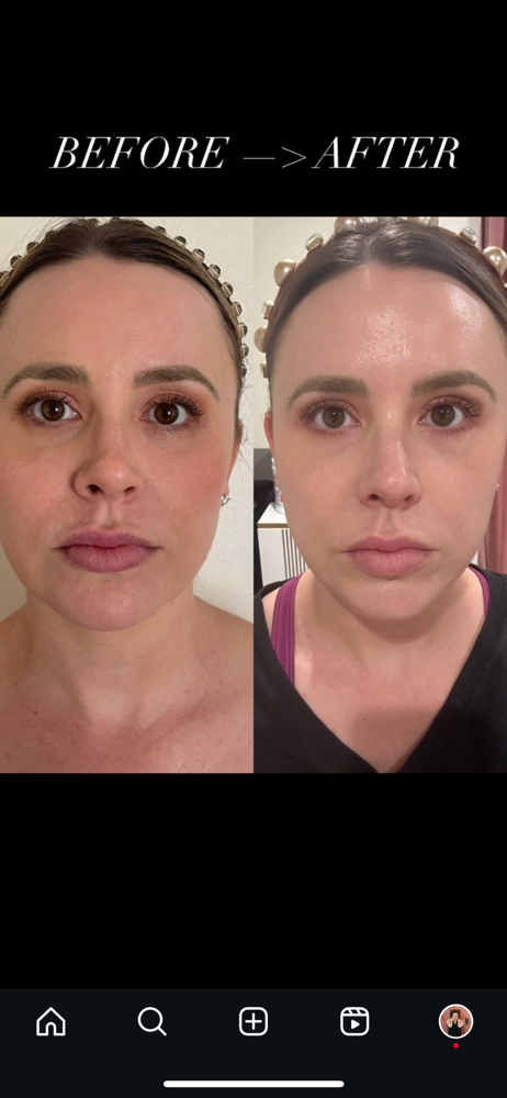 Microneedling
