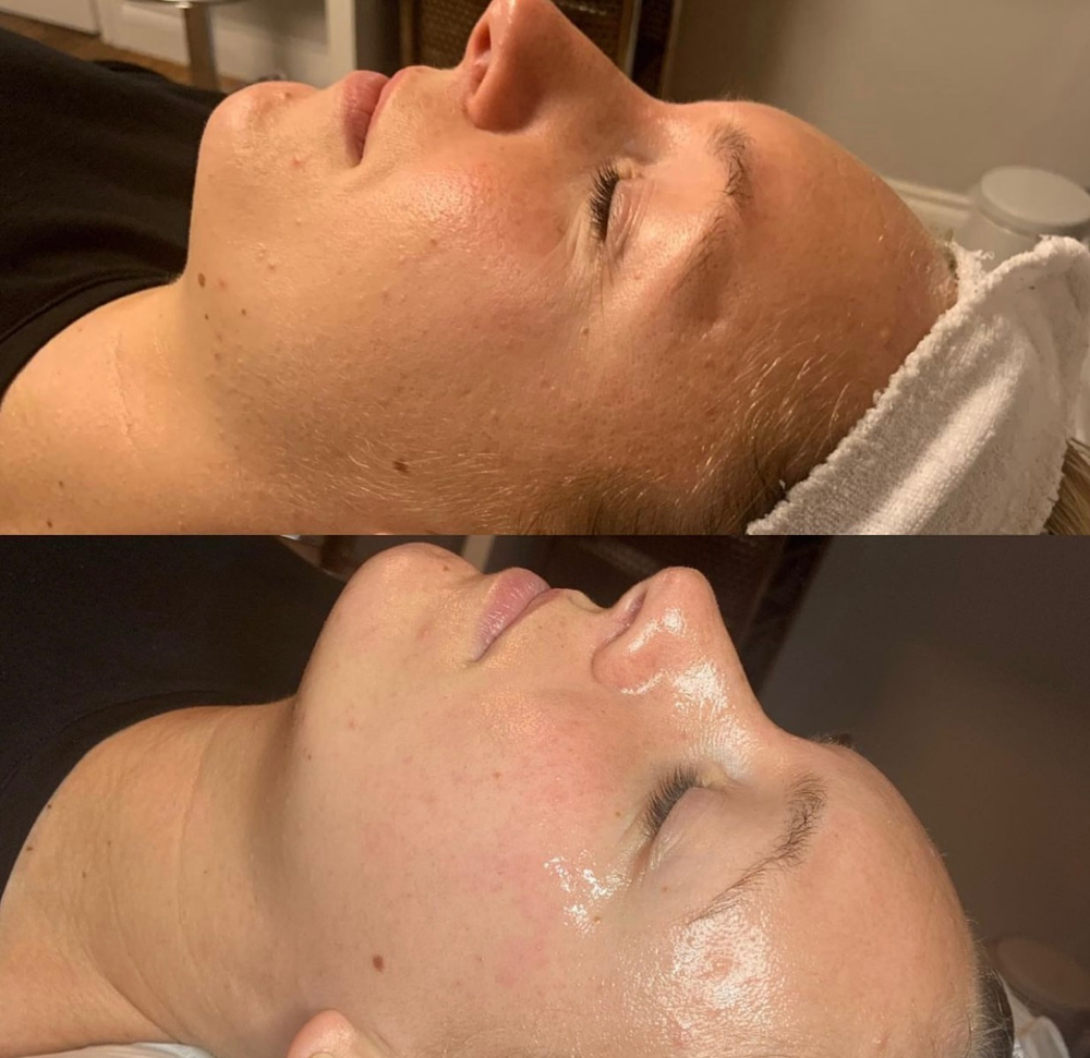 Dermaplane Facial