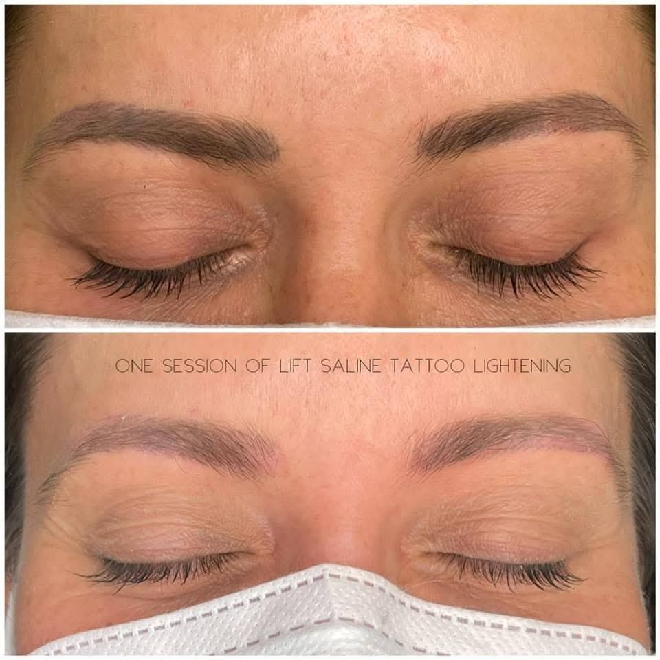 SALINE  REMOVAL