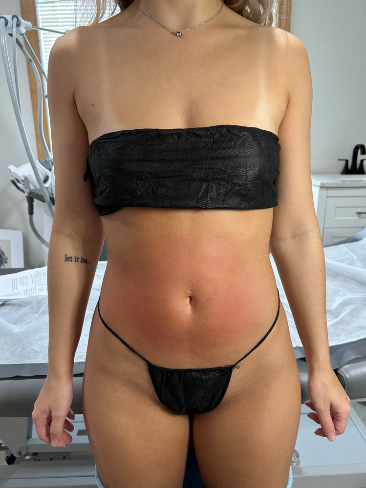 FULL ABDOMEN (FRONT AND FLANKS)