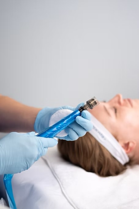 Microneedling (1 Session)