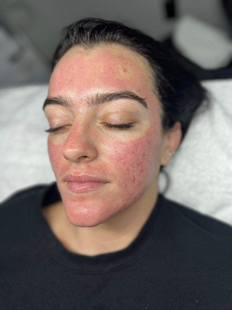 Microneedling