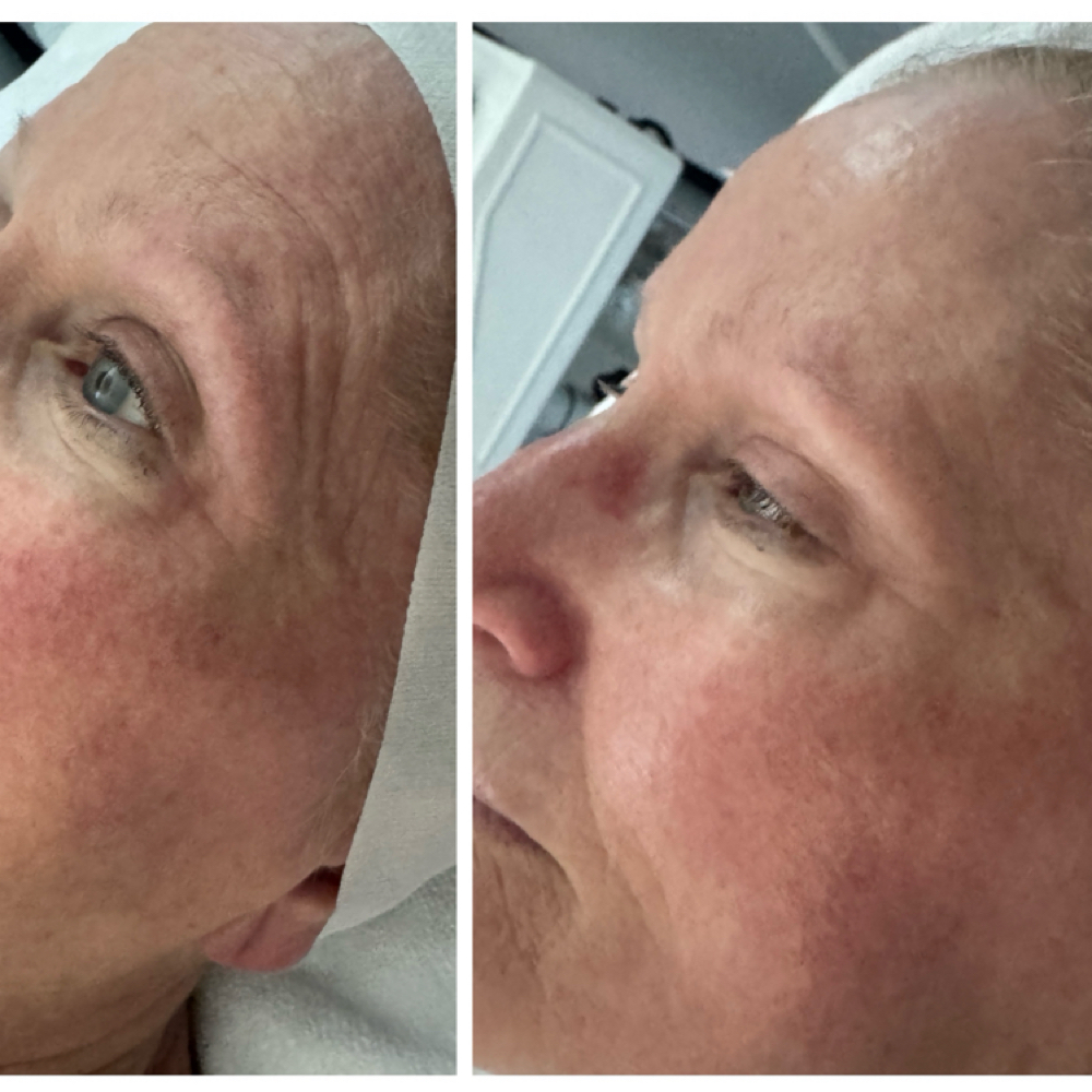 Anti-aging Hydrafacial at Harmony In Beauty in Leawood, KS