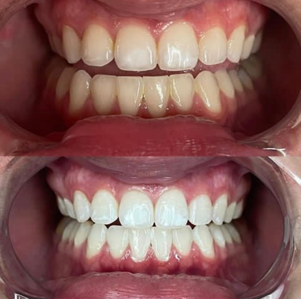 Cosmetic Teethwhitening