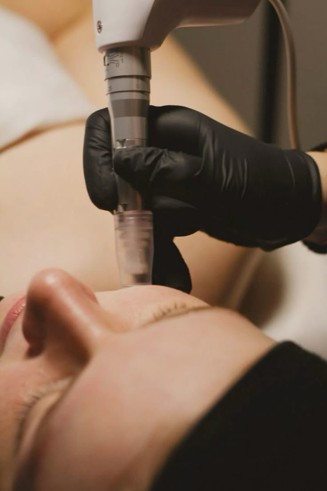 Nanoneedle at Dew Drop Aesthetics LLC in Fort Smith, AR