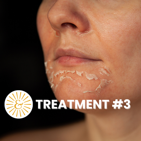 Chemical Exfoliation Series- Txt 3