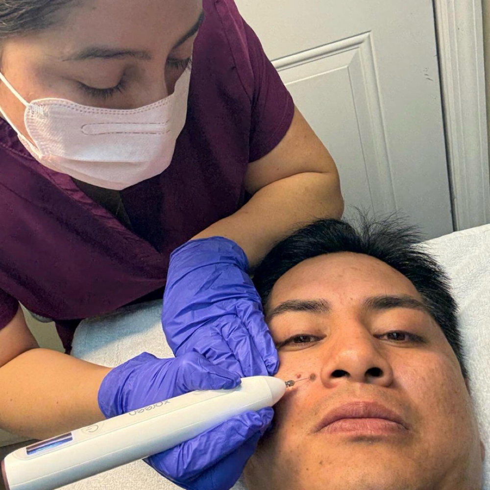 Remoción De Verrugas at Any Beauty Aesthetics Care in New York, NY