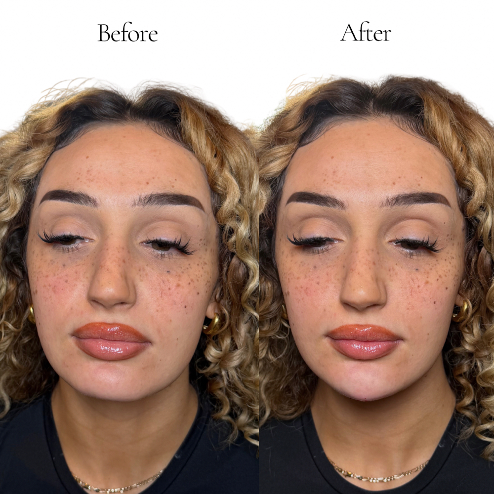 Chin Filler at Etch Aesthetics in rochester, NY