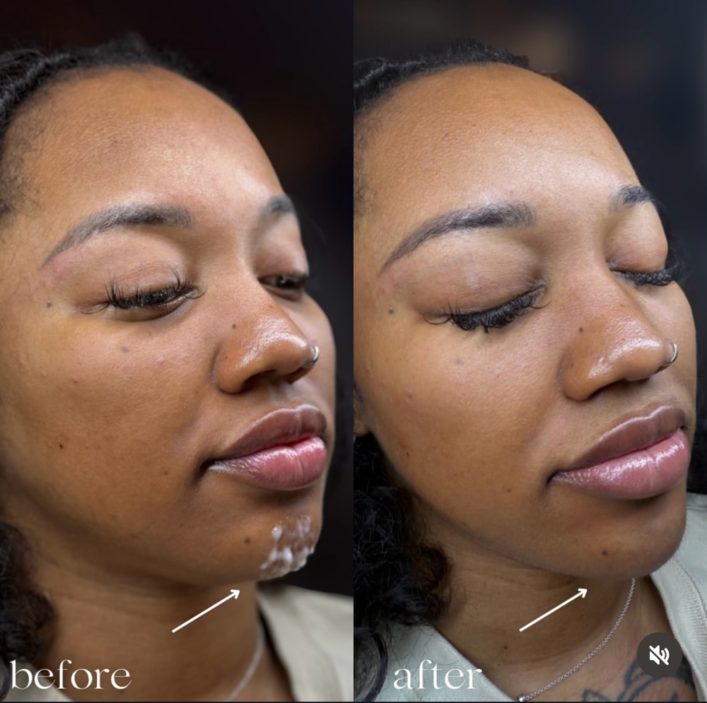 Chin Filler