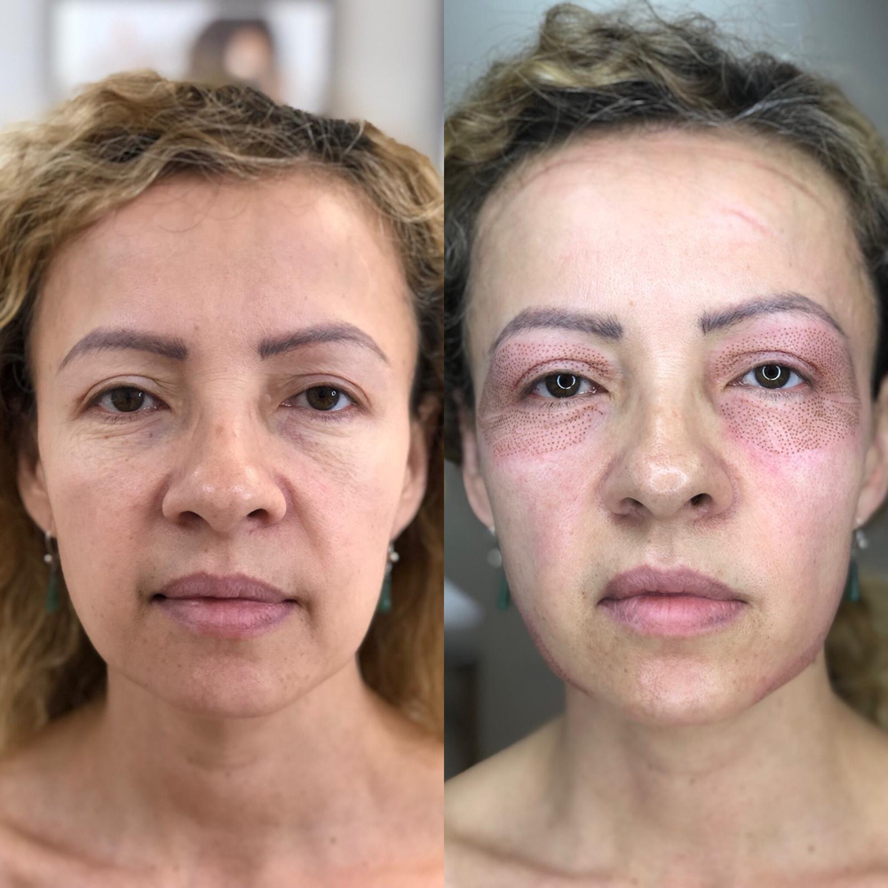 Fibroblast Eyelids at Leidy Cornelio Spa in Aurora, CO
