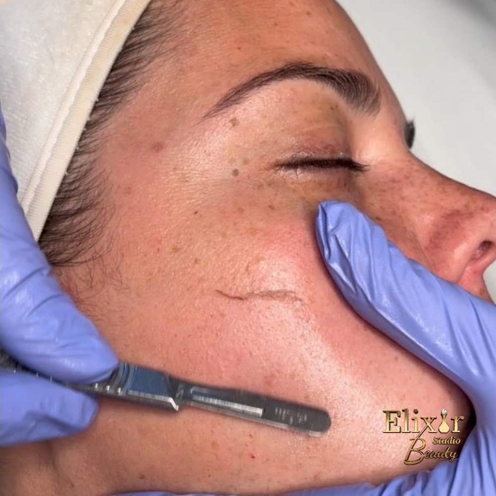 Dermaplaning