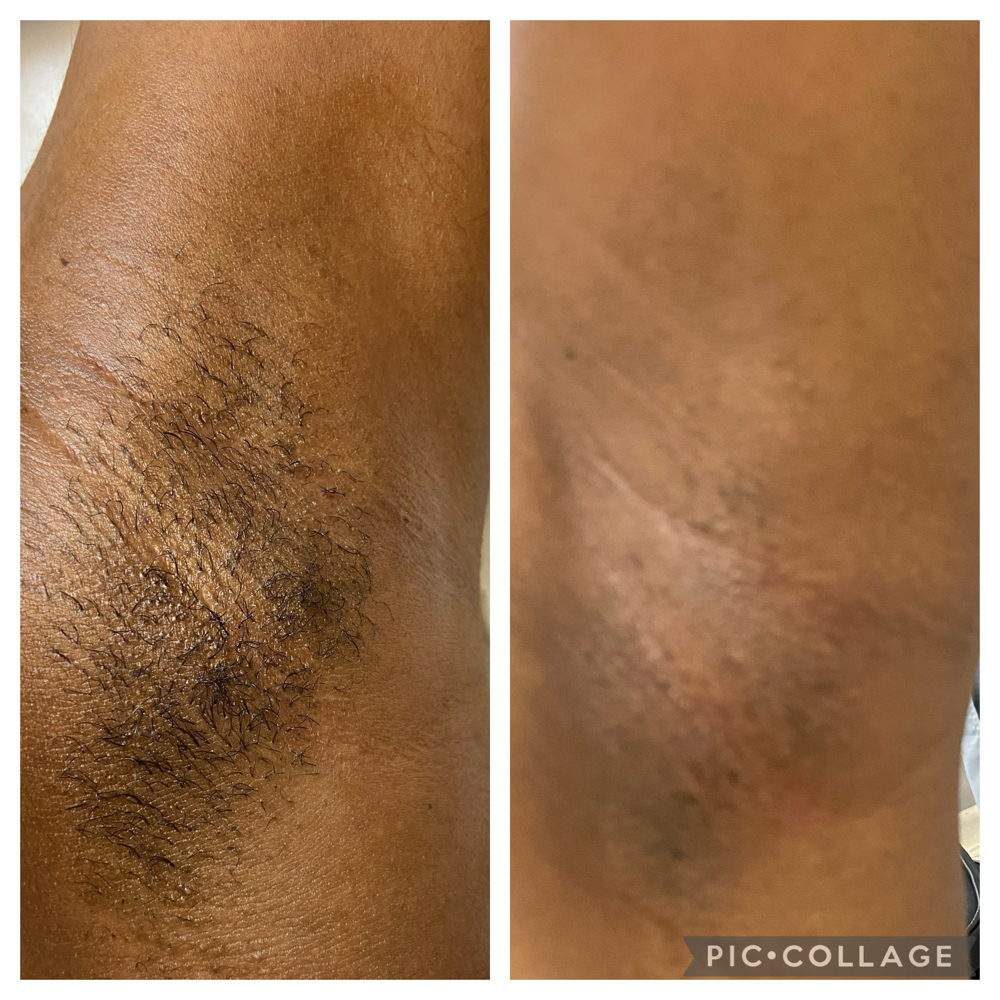 Underarm Hair Removal