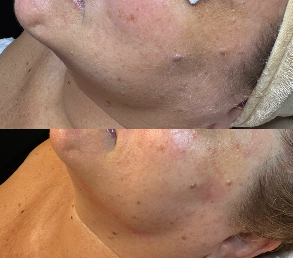 Dermaplane Add-On
